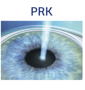 Chirurgie réfractive ou la solution révolutionnaire pour libérer vos yeux